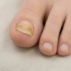 Tratamiento especializado para onicomicosis